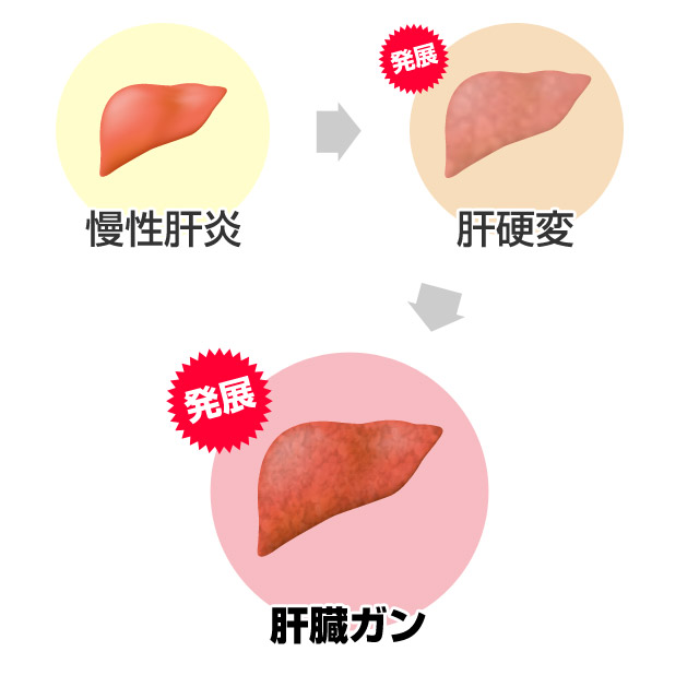 肝臓機能障害