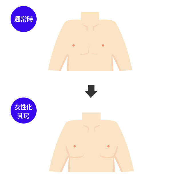 女性化乳房とは