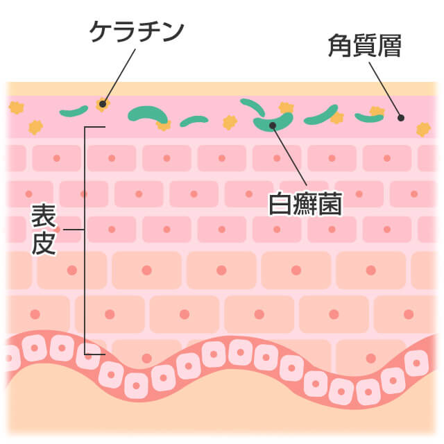 白癬菌は角質層のケラチンを食べて繁殖する