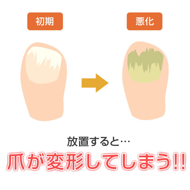 爪白癬は爪に水虫菌が感染したもので放置すると爪が変形する