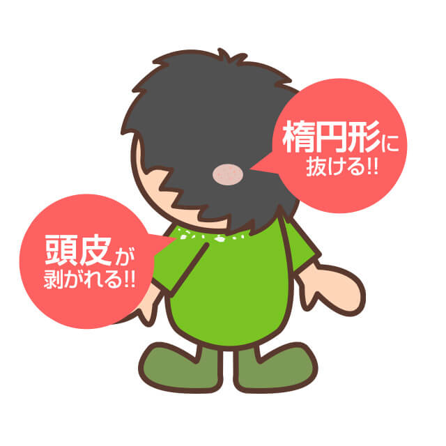 しらくもは爪に水虫菌が髪の毛に寄生したもので髪の毛が抜けて鱗屑が出る