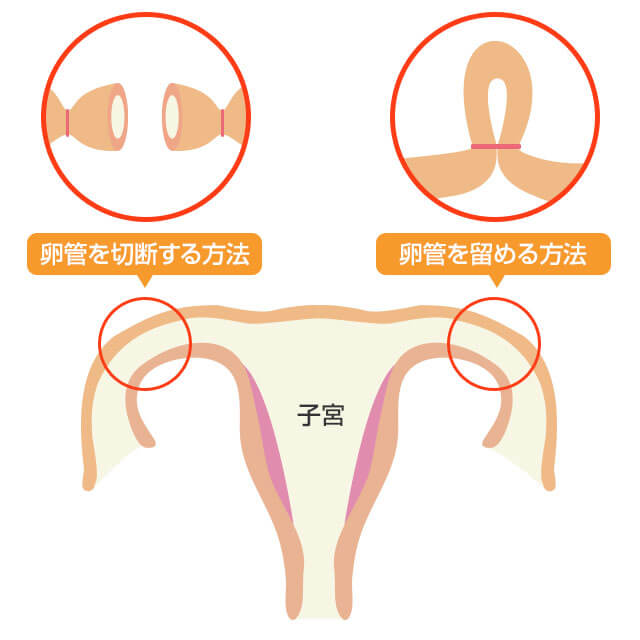 卵管結紮術（卵管を切断・卵管を留める）