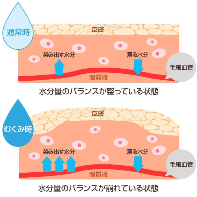 むくみのメカニズムは様々な原因により水分量のバランスが崩れる