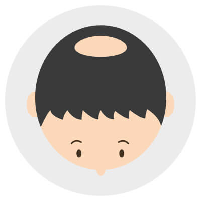 頭頂部から薄毛になるO字ハゲは正面から見ただけでは気づきにくい
