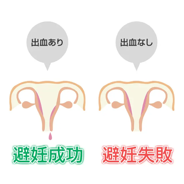 アイピル服用後の出血について
