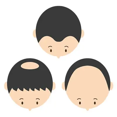 ハゲのタイプについて